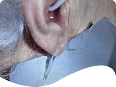 Illustration of earwax removal using a water irrigation technique.